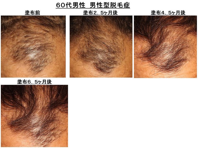 男性型脱毛症　名医""